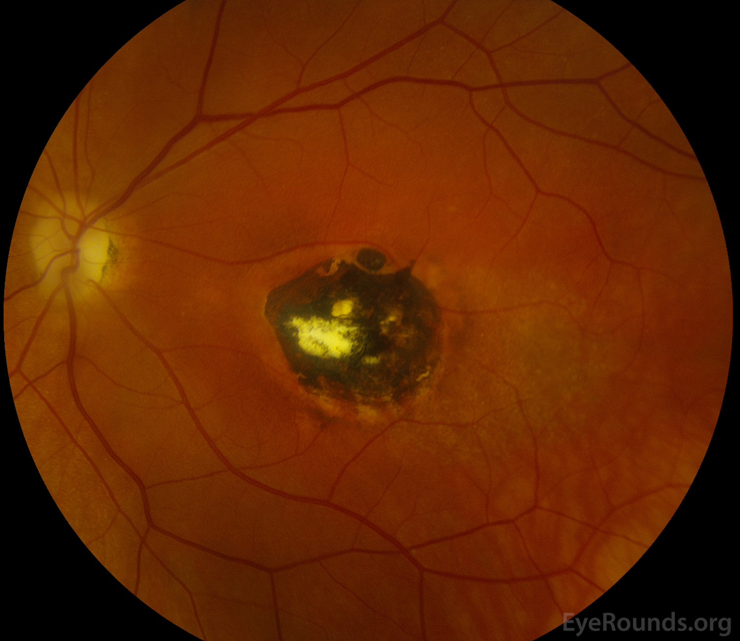 fundus photo showing inactive lesions