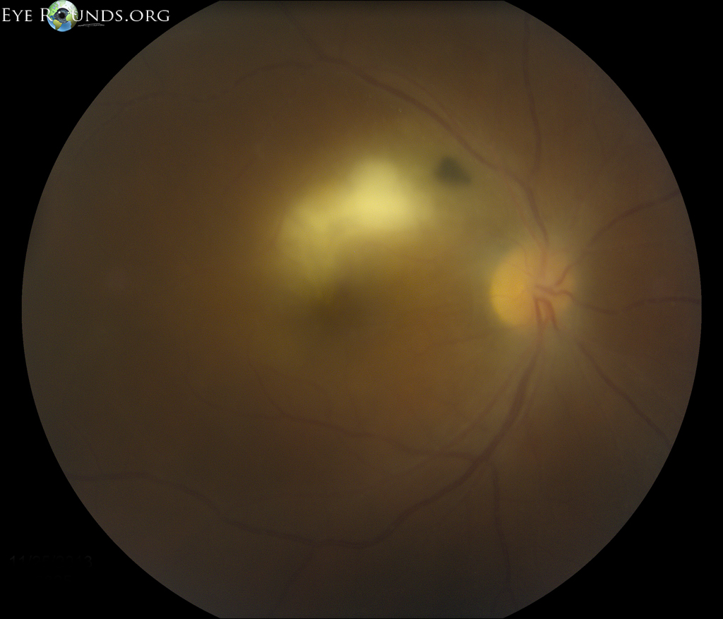 fundus photo showing active lesions