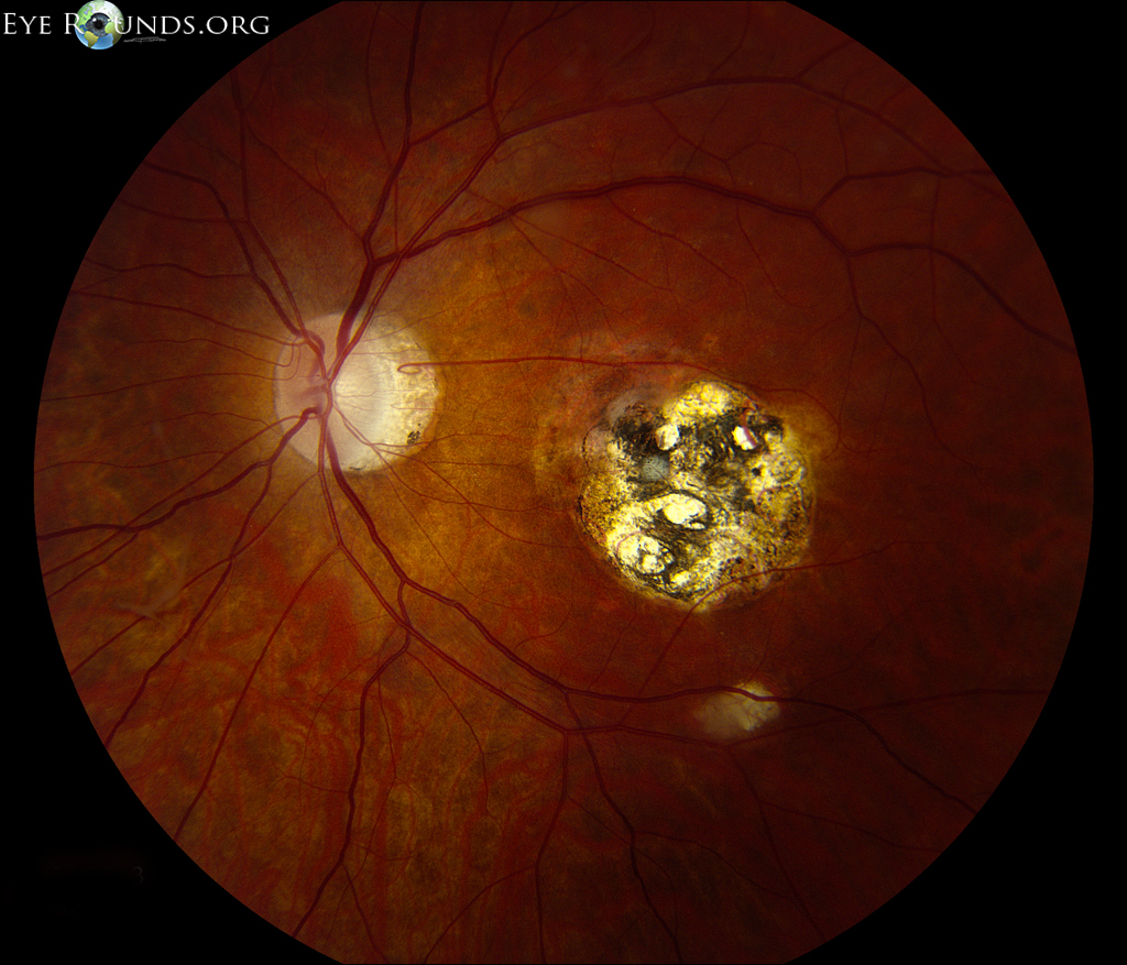 toxoplasmosis retina