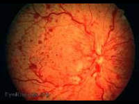 Central Retinal Vein Occlusion (CRVO)