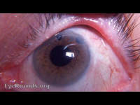 perfect intracapsular cataract operation with two peripheral iridectomies