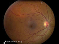 Nevus of Ota