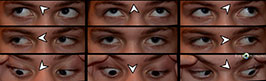 4th Nerve Palsy, Bilateral
