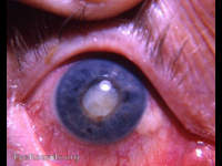 intumescent cataract, anterior uveitis