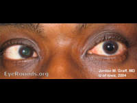 sixth nerve palsy, left eye