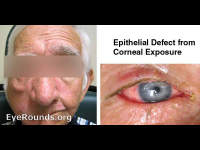 7th nerve palsy