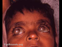 corneal staphyloma with keratomalacia, both eyes