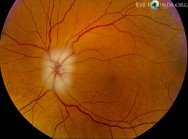 Arteritic anterior ischemic optic neuropathy (AAION) secondary to giant cell arteritis (GCA)