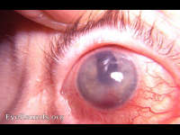 absolute glaucoma with spontaneous hyphema