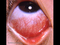 acute mucopurulent bacterial conjunctivitis