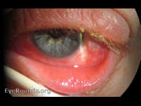 Adenoviral conjunctivitis