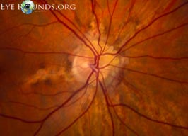 Angioid streaks, optic disk drusen