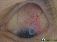 Anterior Scleritis