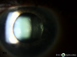 Anterior vitreous inflammation in autoimmune retinopathy
