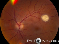 Astrocytoma, Retinal
