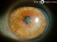 Avellino Dystrophy