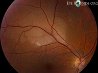 Branch Retinal Artery Occlusion