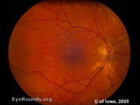 non-proliferative diabetic retinopathy