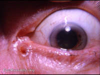 basal cell carcinoma adjacent to inferior canaliculus