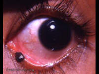 pigmented lesion engulfing the inferior punctum lacrimalis