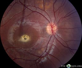 Autosomal Recessive Best Disease