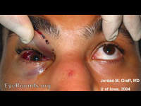Blowout fracture, upgaze restriction
