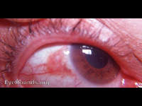 rule out Bowen's disease