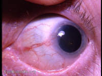 Bowen's disease invading cornea