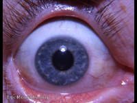 normal variant in iris anatomy in a healthy adult