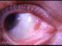 Conjunctiva: bulbar conjunctival papilloma