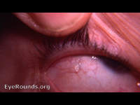 bulbar conjunctival lymph cyst