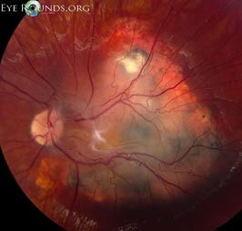 Combined Hamartoma of the Retina and Retina Pigment Epithelium (CHRRPE)