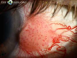 Conjunctival intraepithelial neoplasia