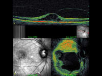 Cystoid Macular Edema (CME), Hyaloid traction