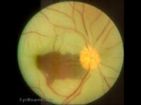 Central Retinal Artery Occlusion (CRAO)