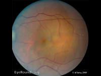 Central Serous Retinopathy (CSR)