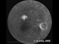 Central Serous Retinopathy (CSR)