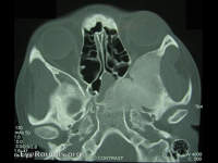 fibrous dysplasia