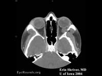 cavernous hemangioma