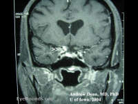 neurosarcoidosis