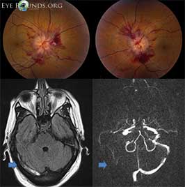 Cerebral venous sinus thrombosis causing intracranial hypertension