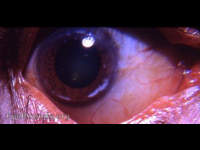 atypically located limbal girdle