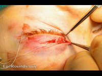 Canalicular Laceration--repair