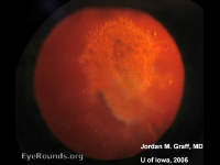 posterior subcapsular cataract, RETROILLUMINATION