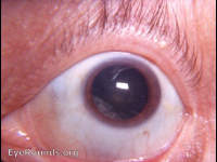 Incipient cataract: most common site