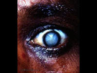 Many patients who came to the Kurji Holy Family Hospital Eye Clinic were described as having " two headlights in their eyes " - a pure white pupil in each eye. The differential lay between the more frequent hypermature Morgagnian cataract and the less frequent intumescent cataract. The intumescent cataract has prominent sectorial markings in the anterior cortex. The hypermature Morgagnian cataract has absolutely no sectorial markings in its completely liquefied anterior cortex. It should be mentioned that many patients presented with a dirty-white pupil. That usually meant a mature senile catarct. A pure-black pupil due to cataract suggested a nuclear cataract. In India, the cataracta nigra was occasionally seen. Before the use of the slit-lamp the cataracta nigra was frequently not recognized as the cause of the patient's blindness - the pupil appeared to be normally black.