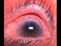 Intracapsular cataract extraction (ICCE) operation in 1977 (Resultant surgical wound repair).