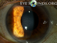 Central cloudy dystrophy of Francois