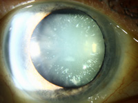 Cerulean cataract