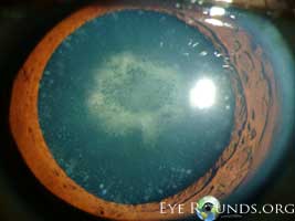 cerulean cataract